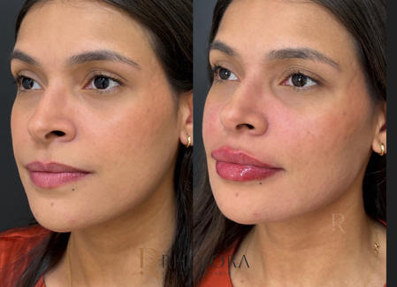 Comparativo antes e depois de paciente da Rhévora, imagem 2