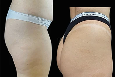 Comparativo antes e depois de paciente da Rhévora, imagem 3