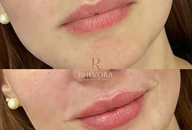 Comparativo antes e depois de paciente da Rhévora, imagem 8