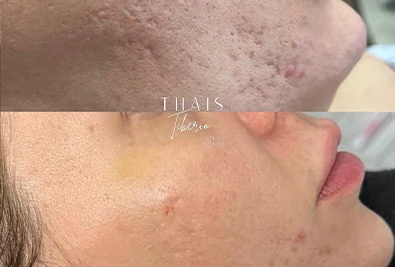 Comparativo antes e depois de paciente da Rhévora, imagem 9