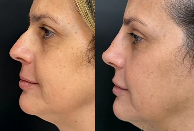 Comparativo antes e depois de paciente da Rhévora, imagem 10