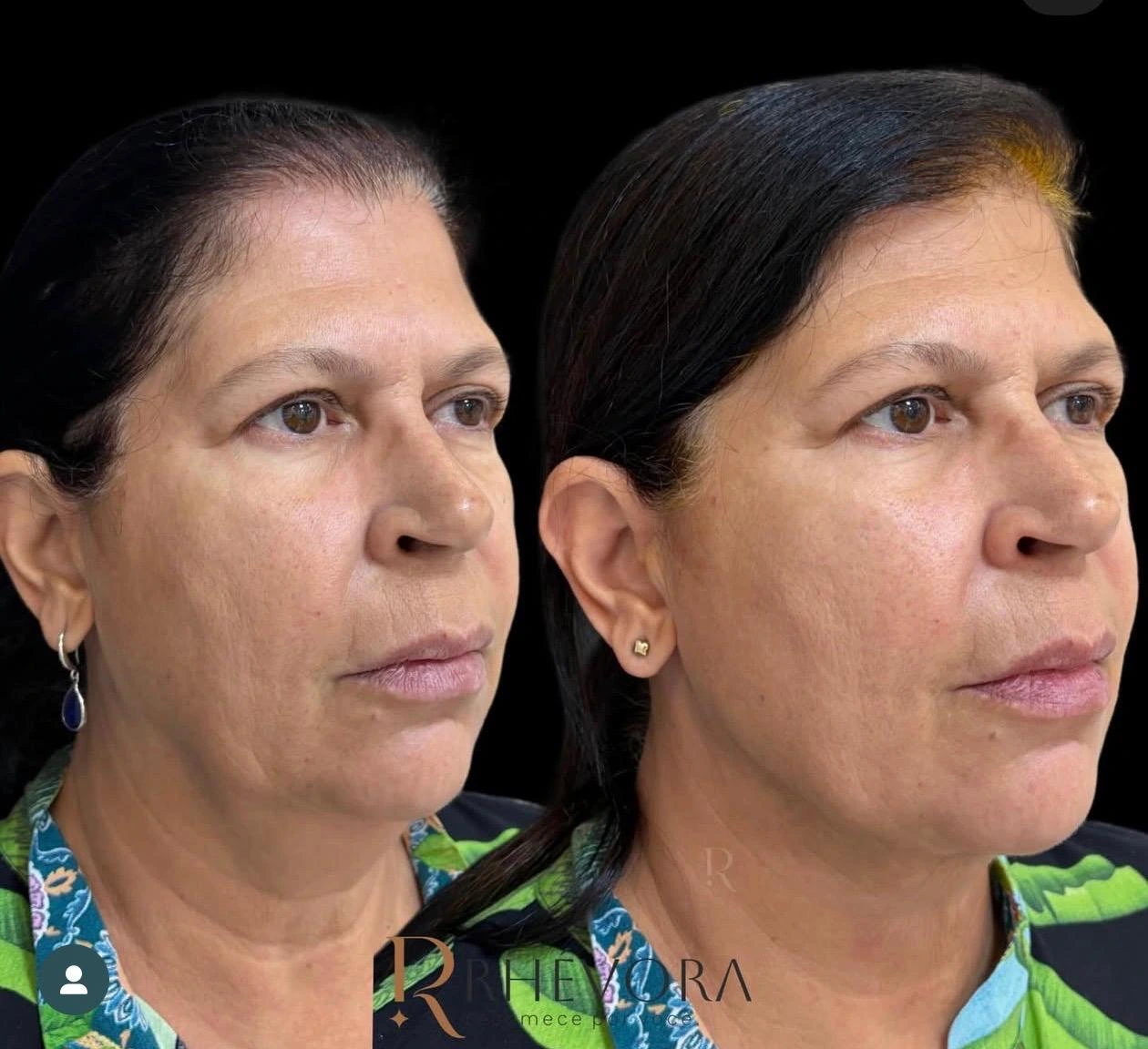 Antes e depois de paciente da Rhévora