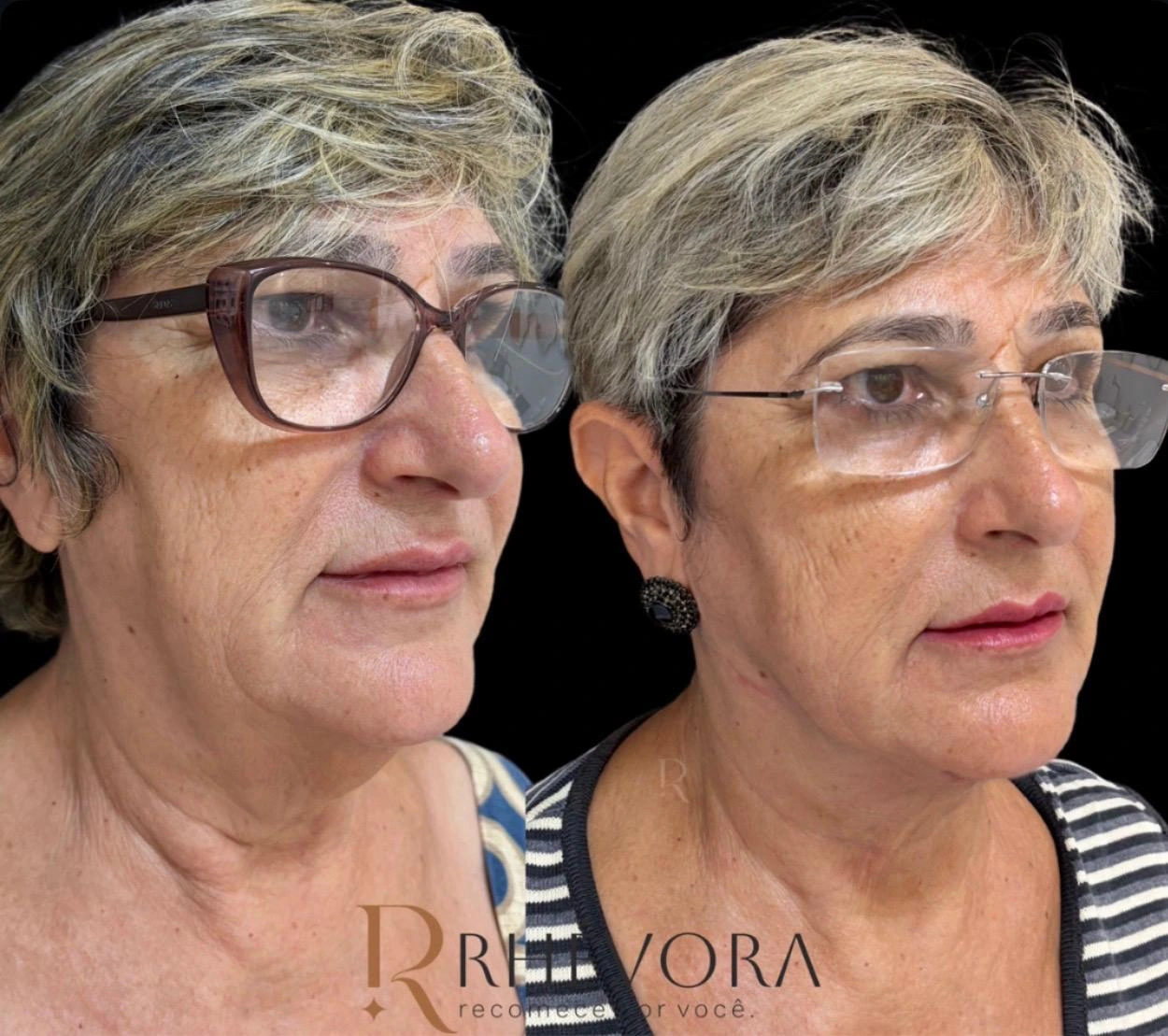 Antes e depois de paciente da Rhévora