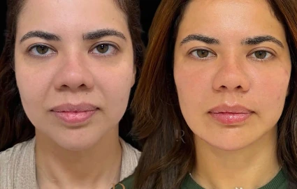 Resultado antes e depois de paciente da Rhévora