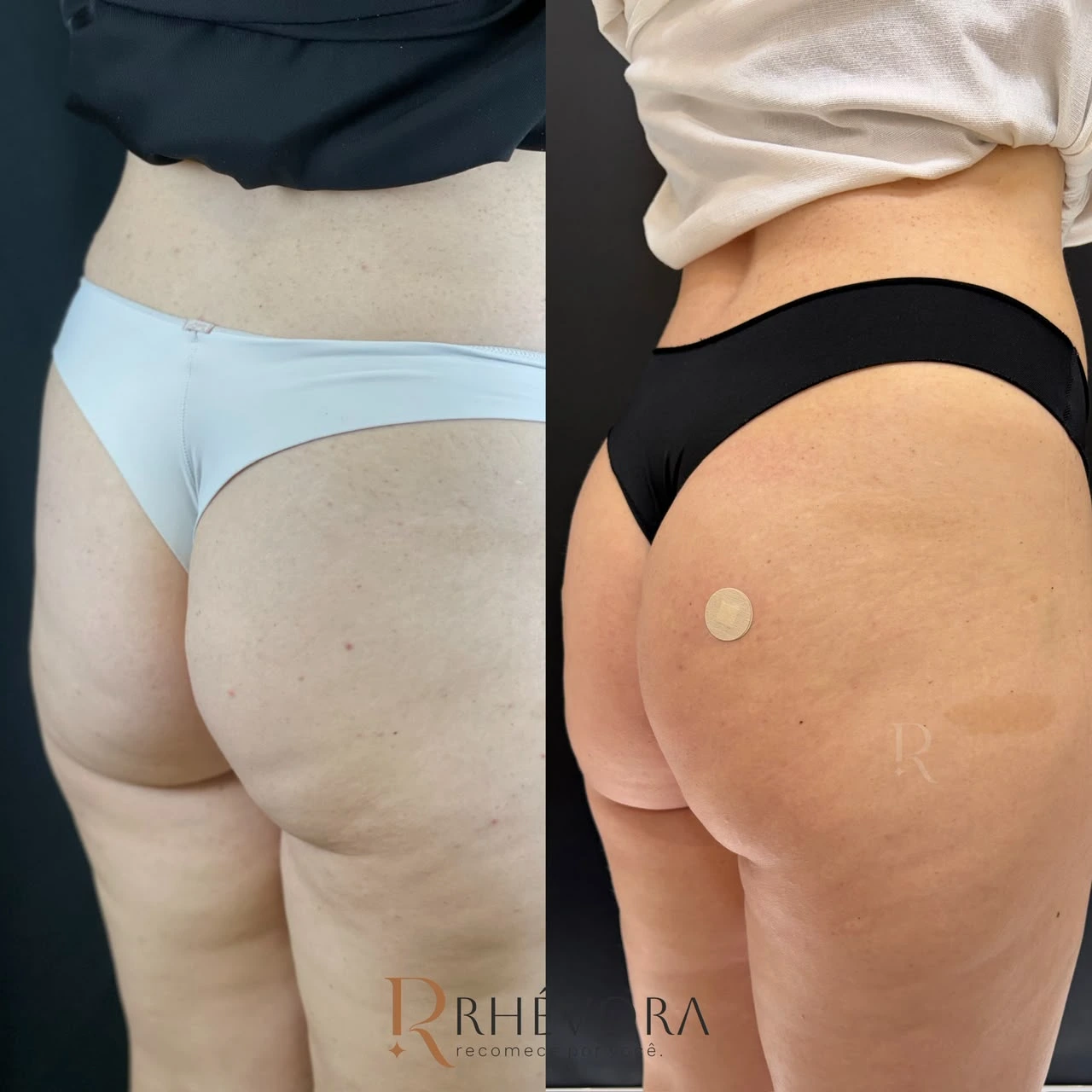 Antes e depois de paciente da Rhévora, novo resultado 3