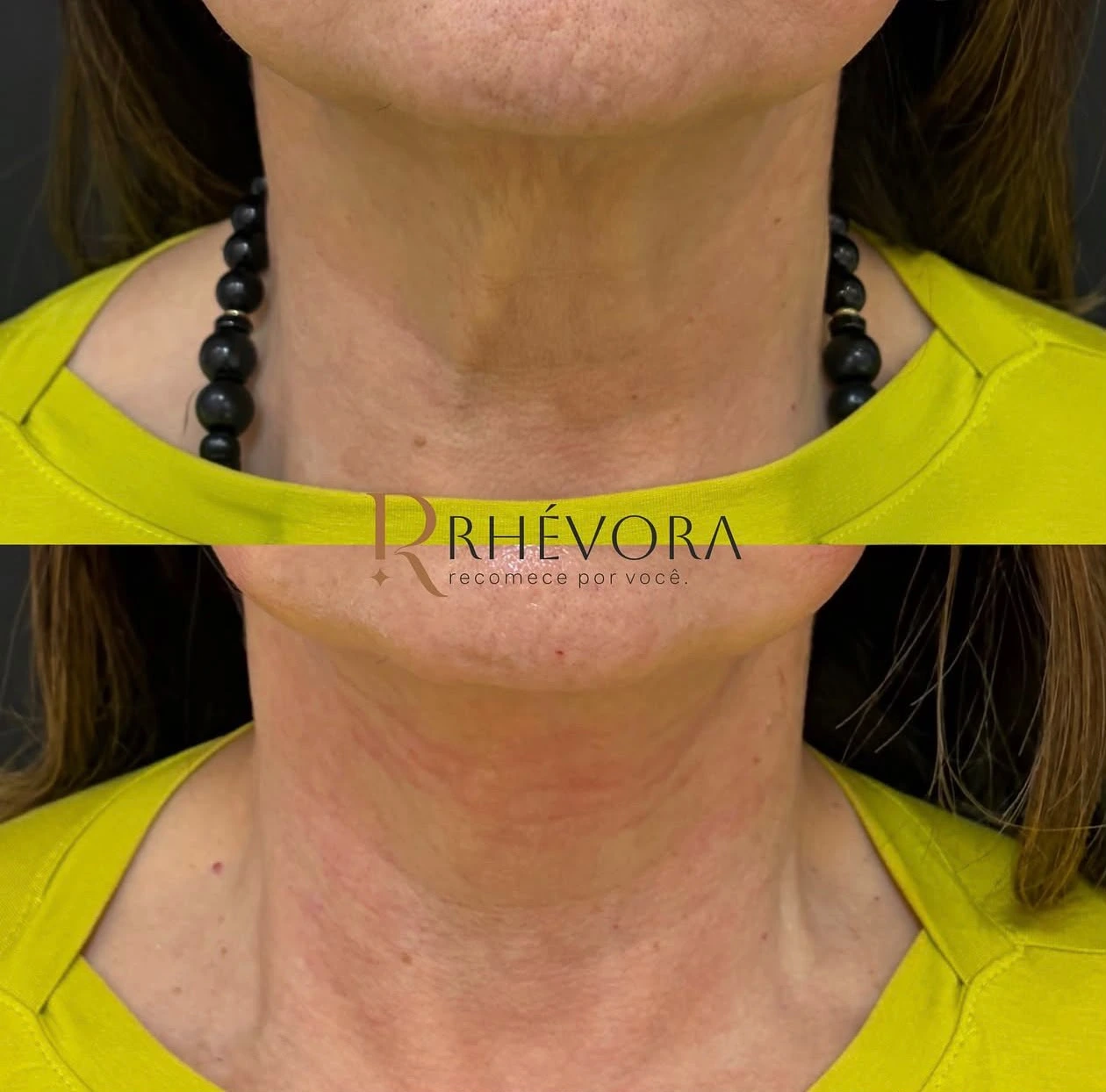 Antes e depois de paciente da Rhévora, novo resultado 7