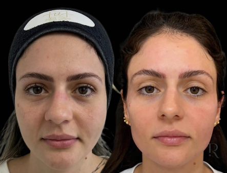 Antes e depois de paciente da Rhévora