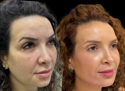 Antes e depois de paciente da Rhévora